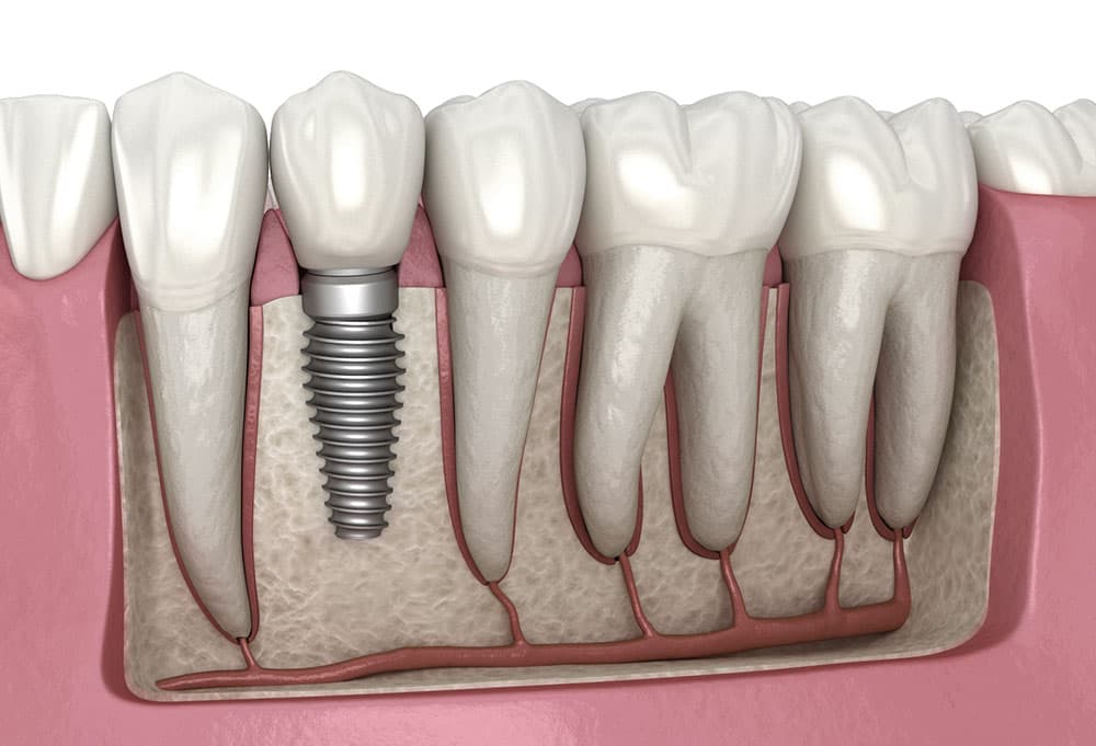 Anatomical illustration of a dental implant placed in the jawbone