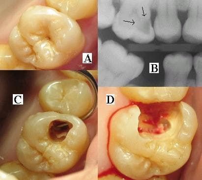 Dental X-ray showing teeth anatomy and any potential issues